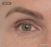 A before and after video showing reduction in fine lines and wrinkles.